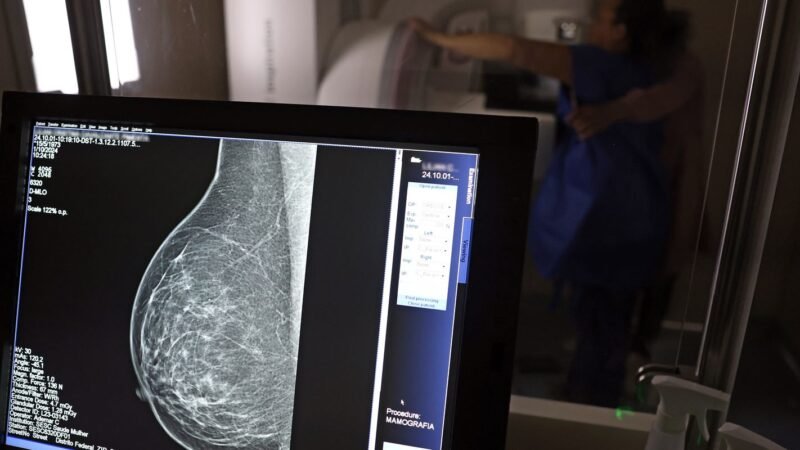 Novo Guia Médico Facilita Acesso à Mamografia Digital